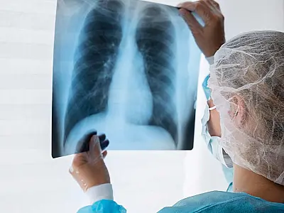 Anvisa aprova novo medicamento para câncer de pulmão avançado