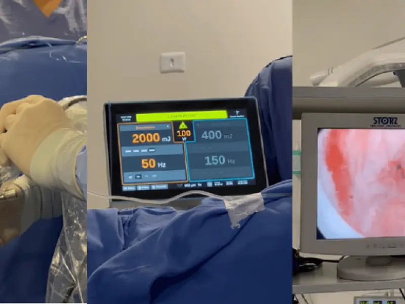 Humap usa laser de alta potência em cirurgias de próstata pelo SUS