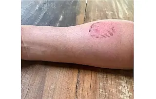 Homem é preso após tentar matar companheira com mordidas no rosto